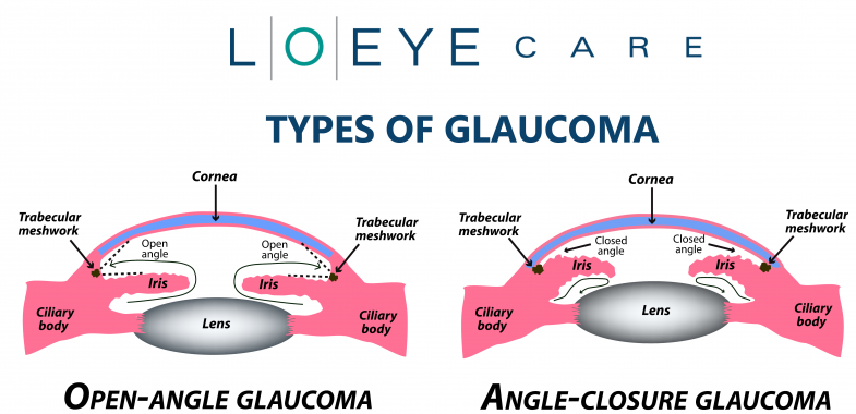 TYPES OF GLAUCOMA