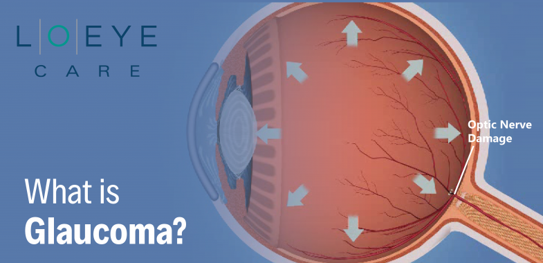 What is glaucoma?