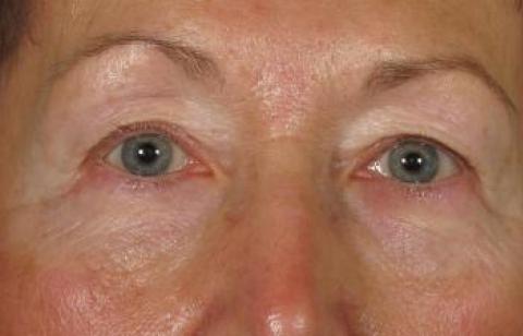 Eyelid Disorders - LO Eye Care