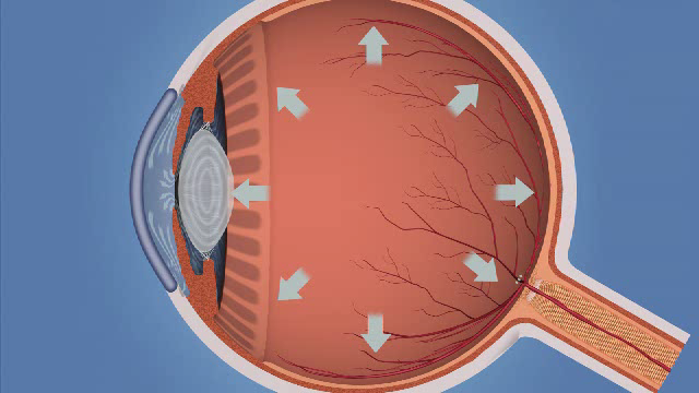 glaucoma glaucoma