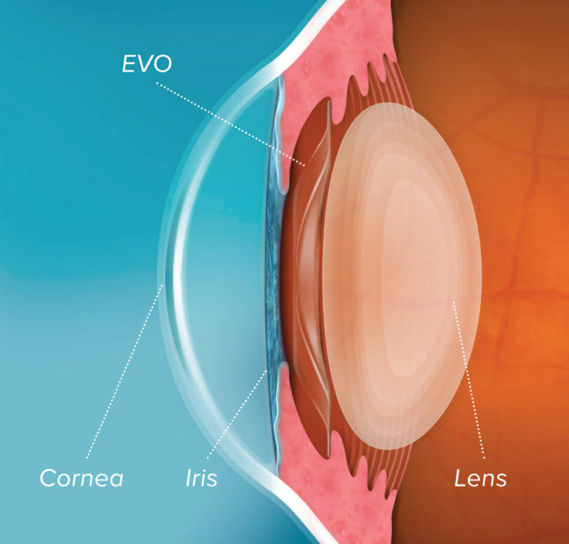 EVO ICL Diagram