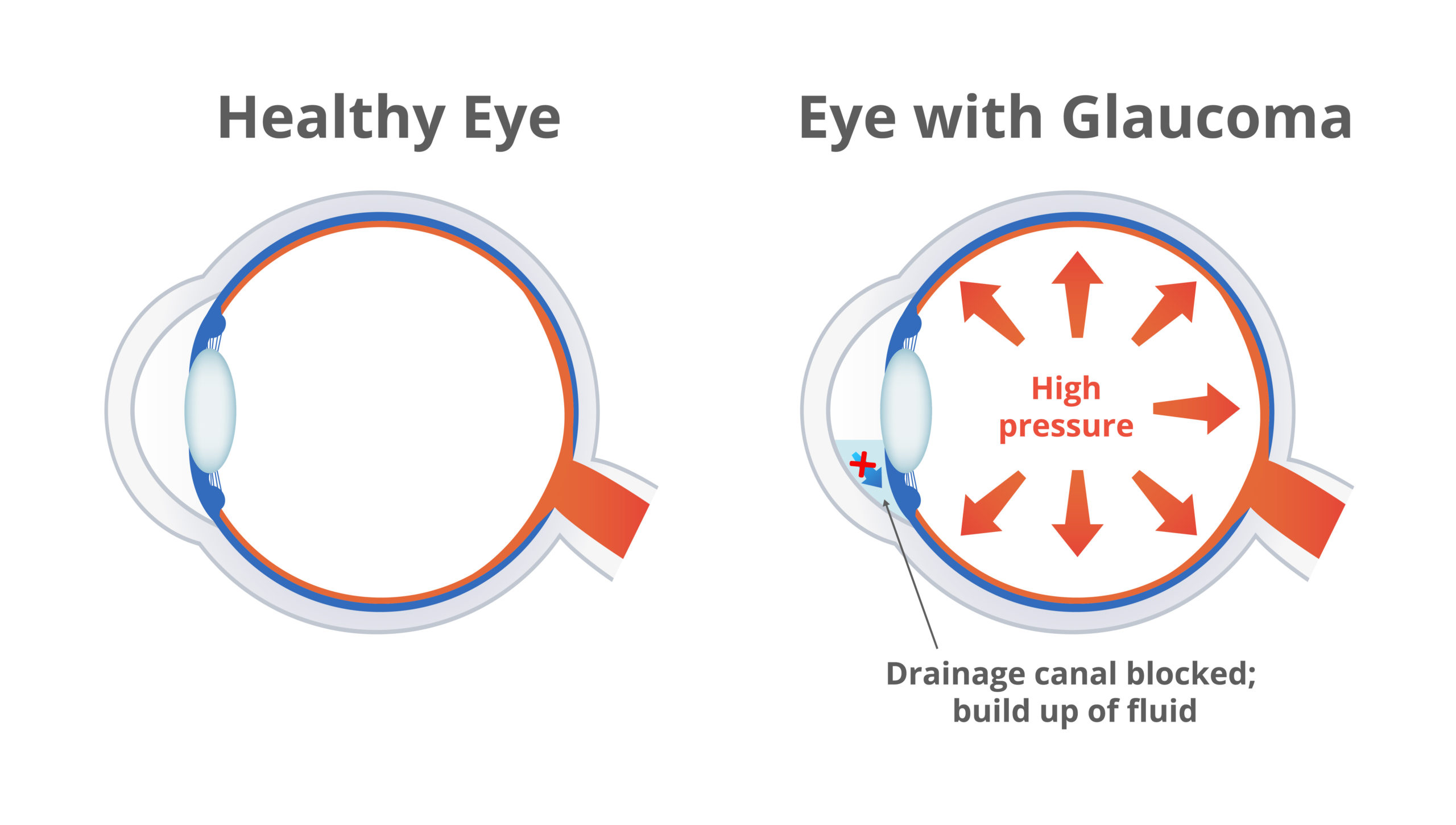Vector illustration of a damaged eye with glaucoma and normal healthy eye isolated. High pressure in the eye damages optic nerves, drainage canal blocked, aqueous humor fluid is build up in the eye.